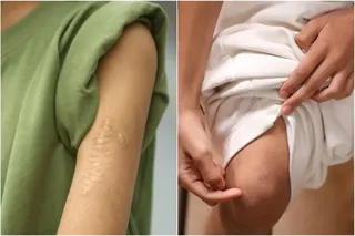 Nurshafira’s scars on her left arm and right knee.