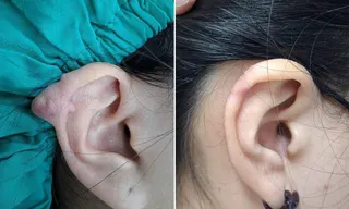 醫師張育誠說明，女大生穿耳洞發生蟹足腫如「精靈耳」（左），經疤痕組織皮下切除，恢...