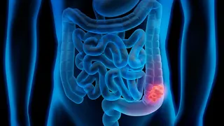 Medical illustration of colorectal cancer in the human body showing the colon