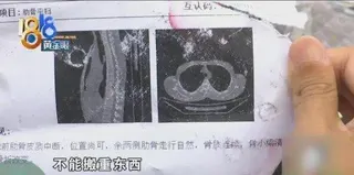影像診斷結果，小李的肋骨骨折。(取材自1818黃金眼)