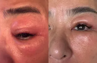 裘海正的眼睛已逐漸消腫。左圖為紅腫初期。（圖／臉書 裘海正）