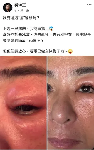 裘海正眼睛遭隱翅蟲接觸感染發腫。翻攝裘海正臉書