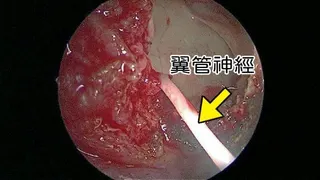 蘇萬福醫師表示，內視鏡經蝶竇找到翼管神經，將截斷2至3公分，可使過敏性鼻炎不容易...