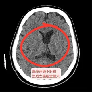 醫師檢查發現腦室兩邊不對稱，出現罕見「腦室隔離」現象。（杏永醫院提供）