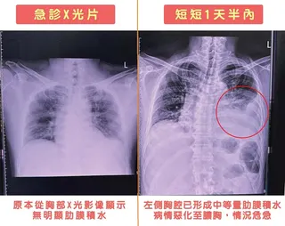 患者因突發性左側劇烈胸痛就醫，短短36小時內病情急速惡化，確診感染罕見「微小微單胞菌」並演變為膿胸。（圖／烏日林新醫院）