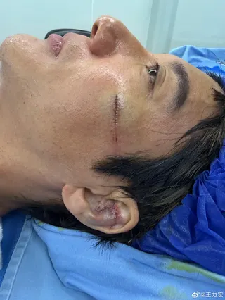 王力宏在4日的演出结束后，到医院共缝了39针。（取自王力宏微博）