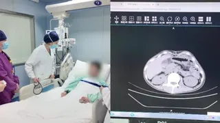 赴泰旅游吃生腌海鲜 上海男子确诊感染阿米巴原虫险丧命